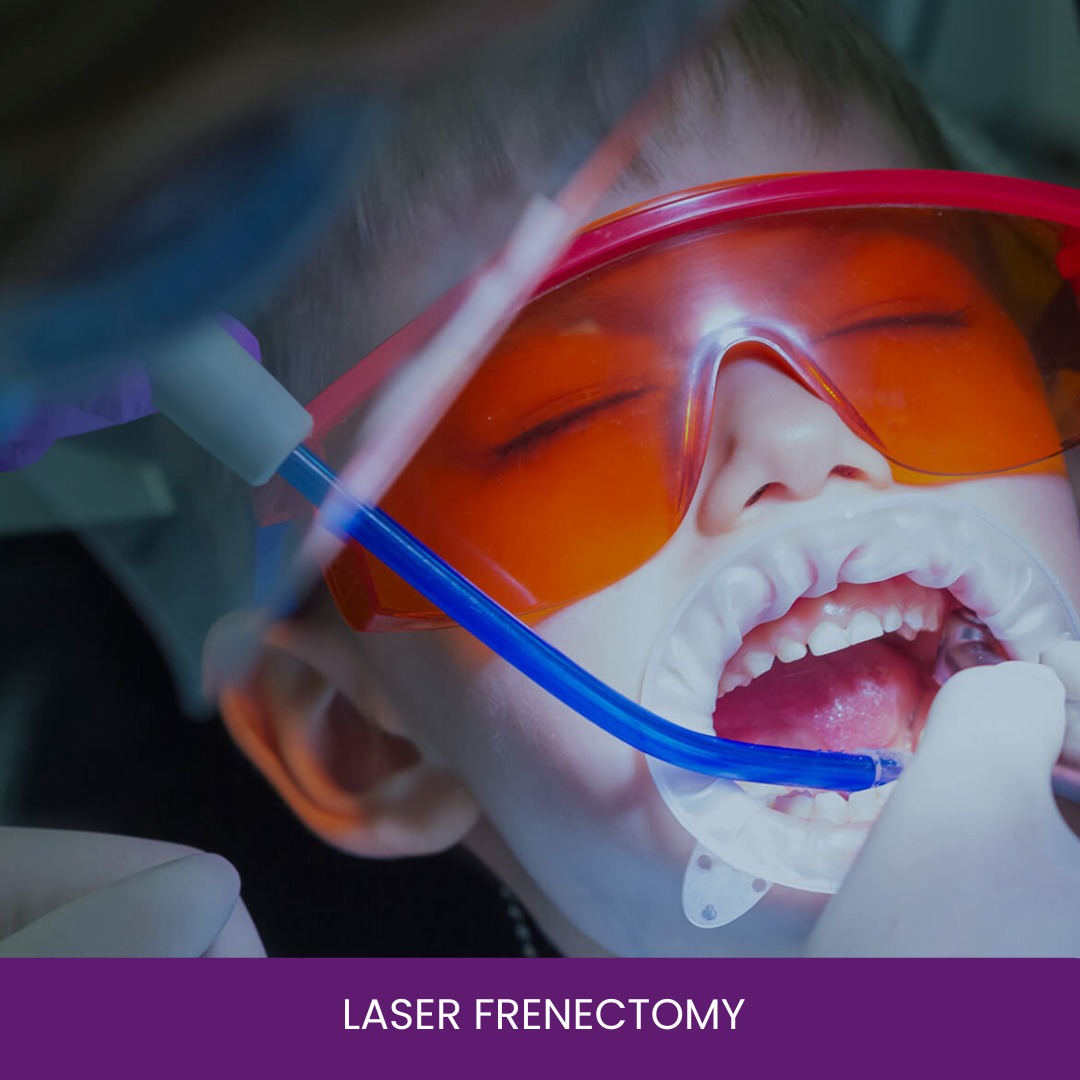 Laser Frenectomy