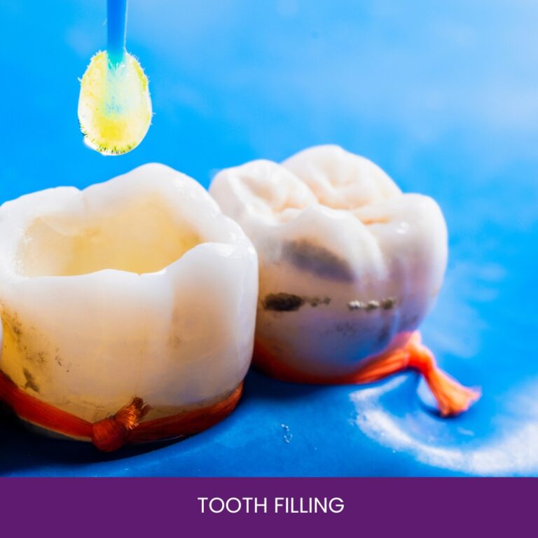 Tooth Filling