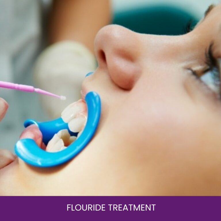 Flouride Treatment