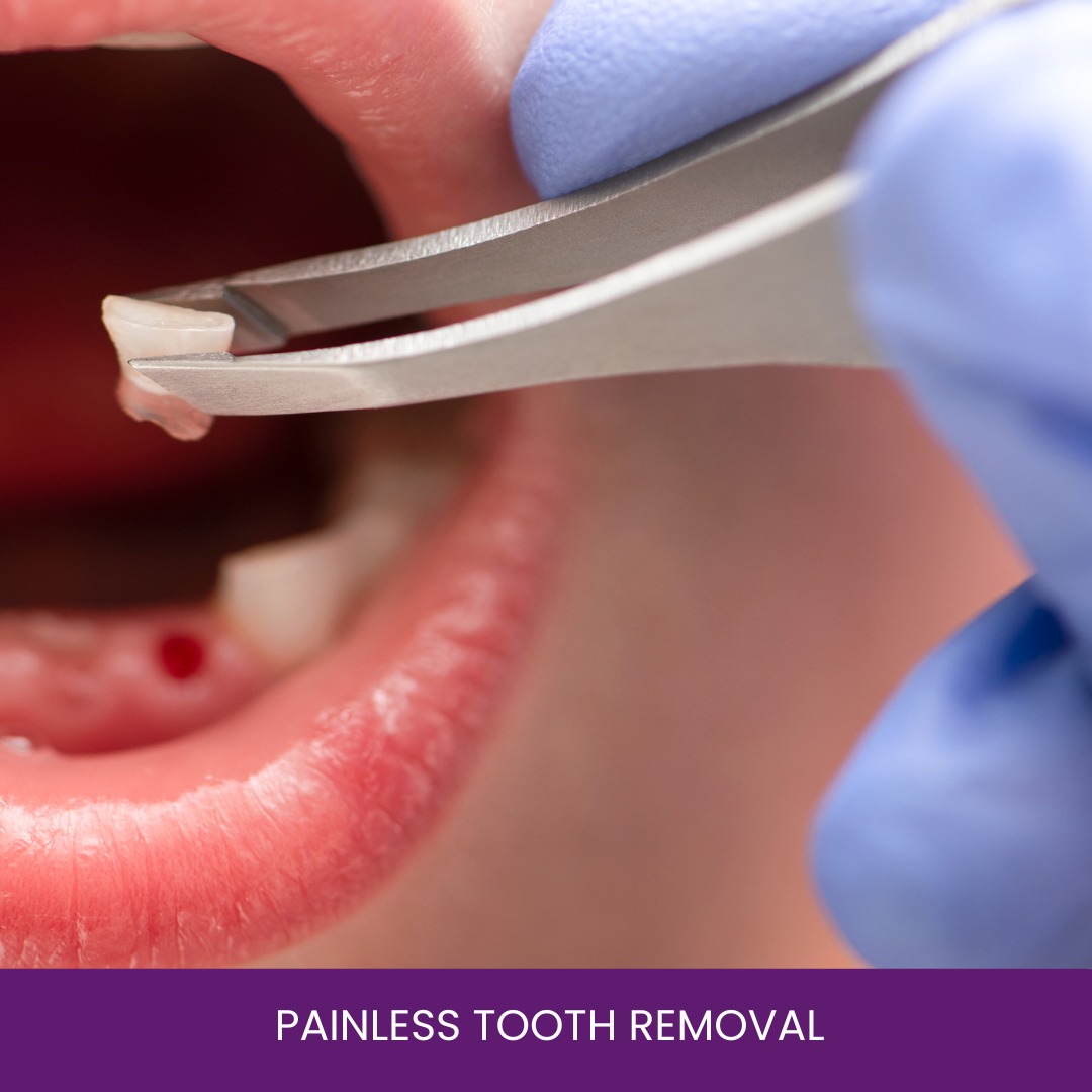 Painless Tooth Removal